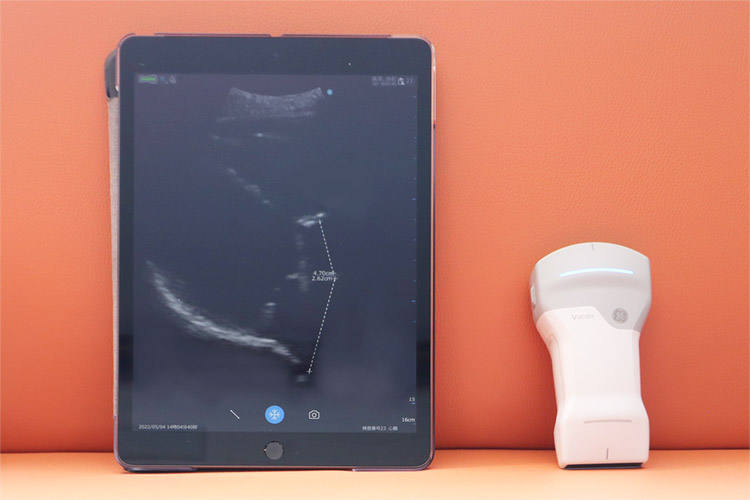 ポータブルエコー